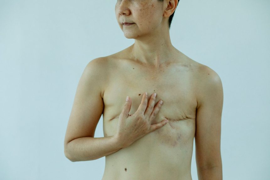Mulher anônima toca a mama com cicatrizes após cirurgia, em fundo branco.